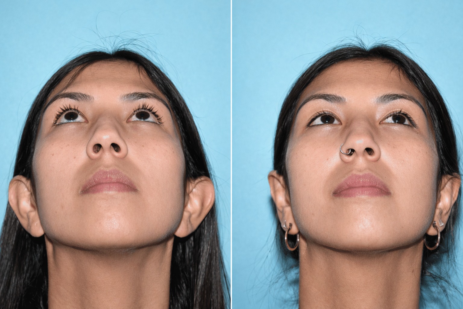 Otoplastia caso 1 — antes y después